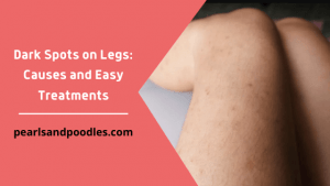 Dark Spots on Legs Causes and Easy Treatments